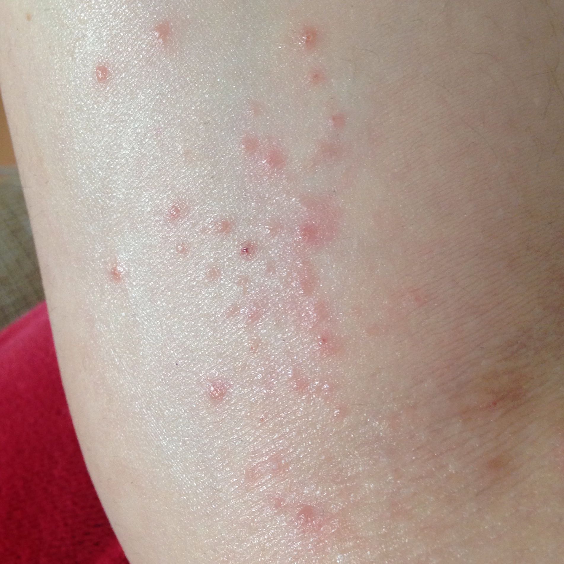 Ausschlag Was könnte es sein (Allergie, Neurodermitis)? (Medizin, Haut